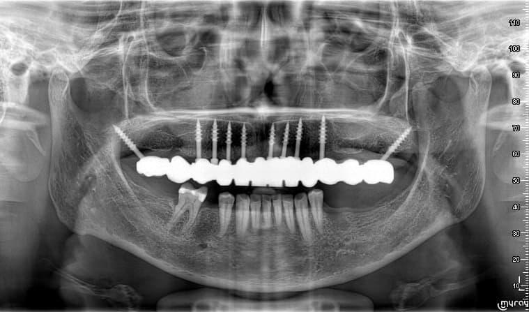 Implantes Cigomáticos