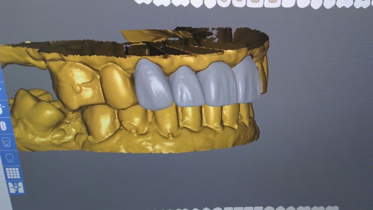 Carillas E-MAX