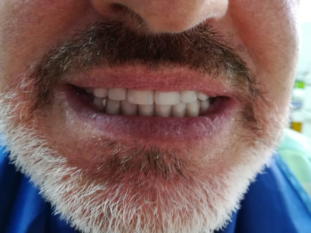 sonrisa con la restauracion con implantologia estrategica implantes dentales carga inmediata implantes basales bogota-chia-la-calera-zipaquira-colombia