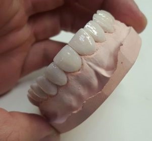 diseño de sonrisa dental realizado con carillas dentales en resina dental