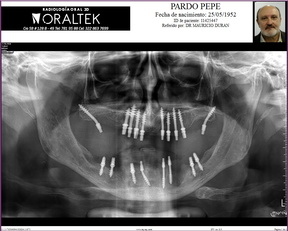 radiografia con implantes dentales carga inmediata bogota-chia-la calera colombia