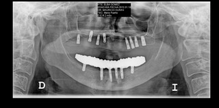 alla on four radiografia con implantes dentales