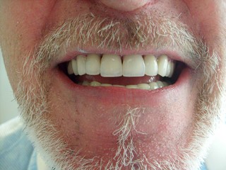 implantes-dentales-carga-inmediata implantes-dentales-basales coronas-zirconio resinas-cad-cam-cerec-implantologia estrategica bogota-chia-la-calera-zipaquira colombia