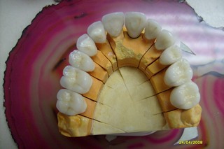 coronas dentales en zirconio dental