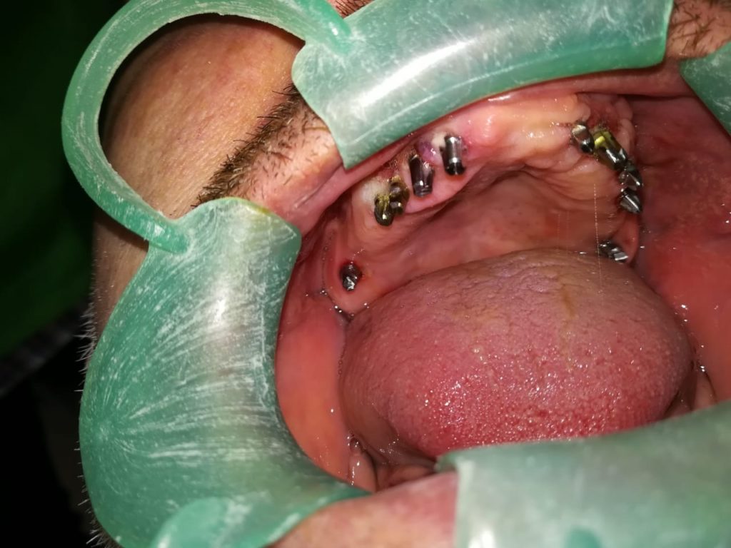 implantologia estrategica superior con implantes dentales carga inmediata implantes dentales basales-bogota-chia-la-calera-zipaquira-colombia 