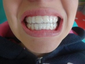 ortodoncia invisibles sin brackets placas esteticas para mover los dientes bogota-chia-la- calera-zipaquira-colombia
