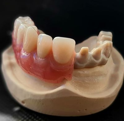 protesis-hibrida- all- on- four -protesis -atornillada -estructura- peek – carbono-dientes fijos en grafeno(graheno dental sin-metal-bogota-chia-cajica-zipaquira-la calera-colombia implantologia estrategica precios especiales.
