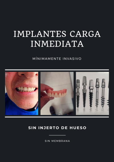 implantes carga inmediata minimaamente invasivo-sin injerto de hueso-dientes estables en 24-72 horas.  