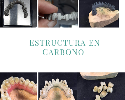 estructura para protesis dental hibrida estructura en carbono