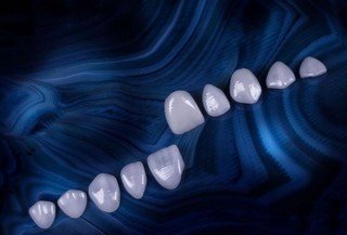 Diseño de Sonrisa carillas zirconio disilicato de litio