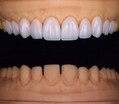 Carillas de Zirconio diseño de sonrisa carillas zirconio disilicato de litio