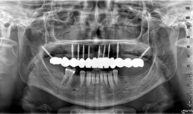 radiografia panoramica con los implantes dentales y coronas en zirconio