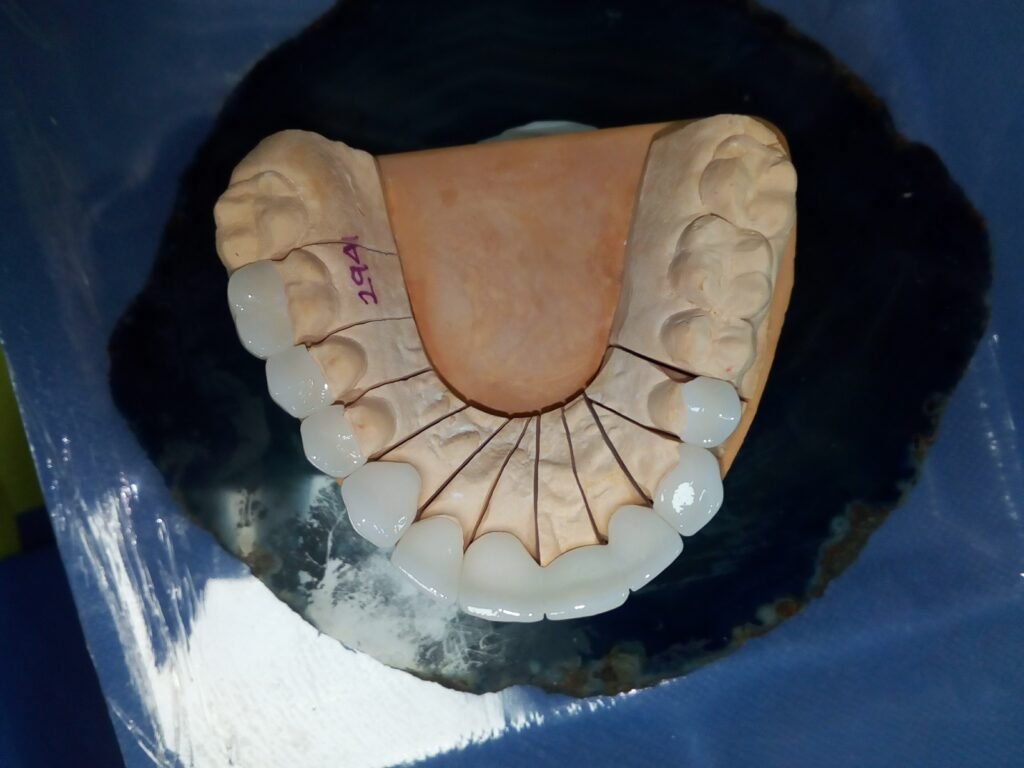 CORONAS DENTALES EN ZIRCONIO DENTAL POR PALATINO