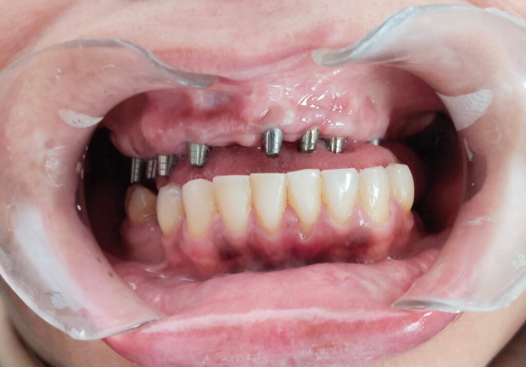 implantes dentales de carga inmediata el dia de la cirugia
