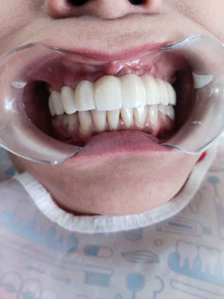 coronas en zirconio dental fijas a los implantes dentales de carga inmediata