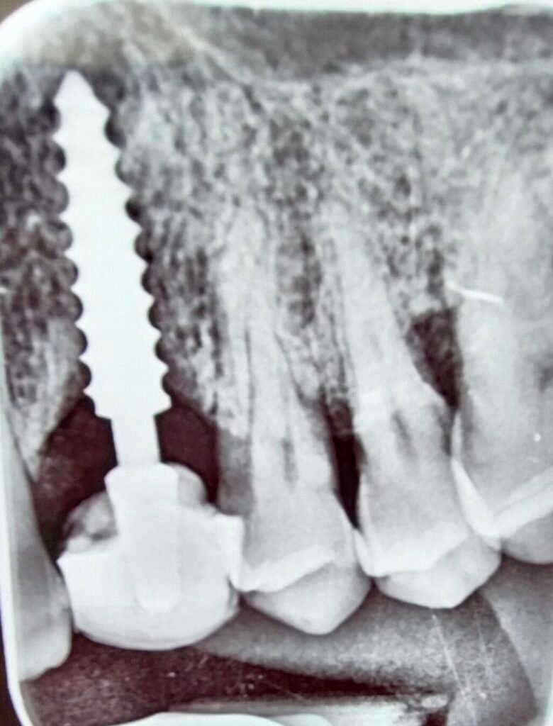 implante dental compresivo carga inmediata