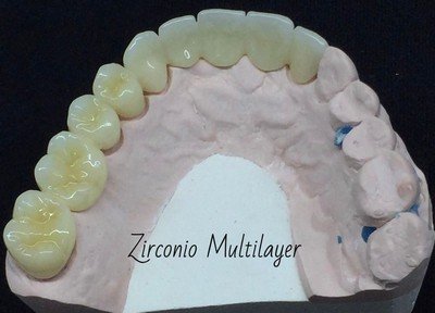 CORONAS DENTALES EN ZIRCONIO MULTILAYER