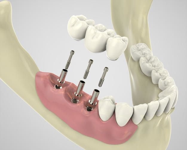 implantes dentales prótesis atornillada