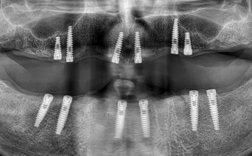 implantes dentales bifasicos